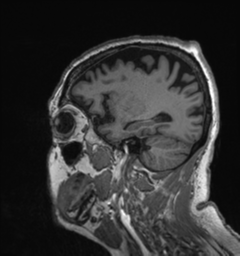 Behavioral variant frontotemporal dementia and late onset schizophrenia (Radiopaedia 52197-58083 Sagittal T1 78).png