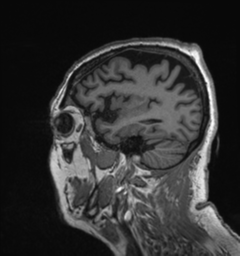 Behavioral variant frontotemporal dementia and late onset schizophrenia (Radiopaedia 52197-58083 Sagittal T1 83).png