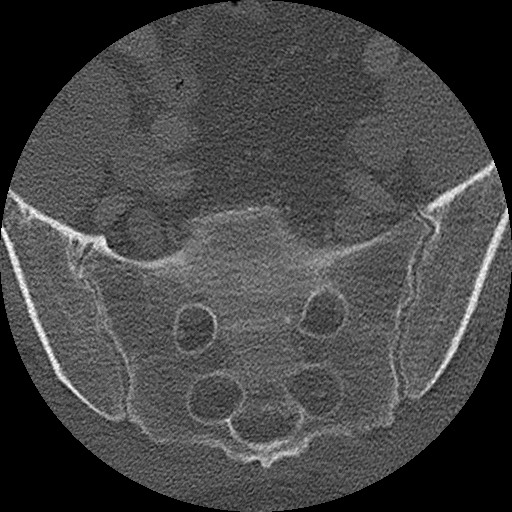 Benign post-traumatic pseudopneumoperitoneum (Radiopaedia 71199-81495 Axial bone window 296).jpg