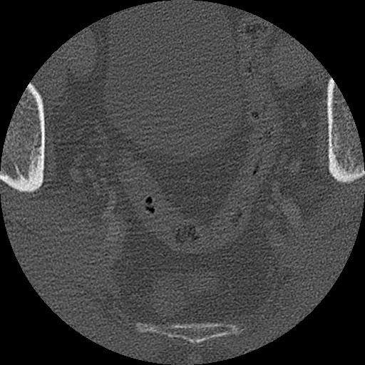 Benign post-traumatic pseudopneumoperitoneum (Radiopaedia 71199-81495 Axial bone window 314).jpg