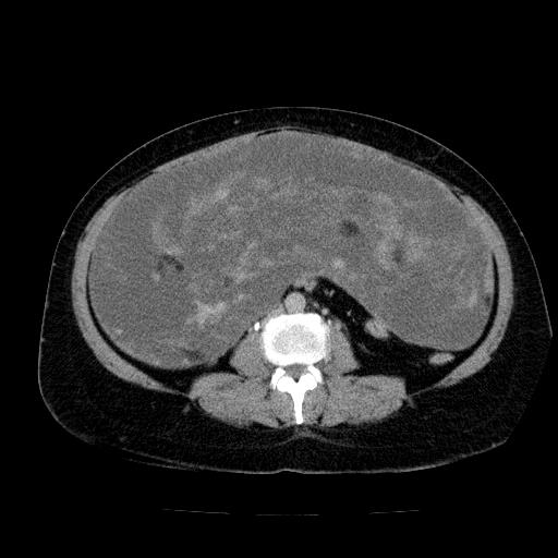 Benign spindle cell tumor - abdominopelvic (Radiopaedia 61300-69212 Axial C+ delayed 35).jpg