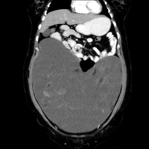 File:Benign spindle cell tumor - abdominopelvic (Radiopaedia 61300-69212 C 20).jpg
