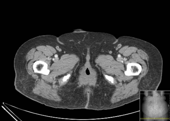 Bicameral celiacomesenteric aneurysm (Radiopaedia 55766-62327 A 82).jpg