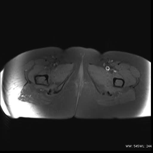 File:Bicornuate uterus- on MRI (Radiopaedia 49206-54297 Axial T1 fat sat 22).jpg