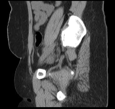 File:Bicornuate uterus (MRI) (Radiopaedia 49206-54296 Sagittal 12).png