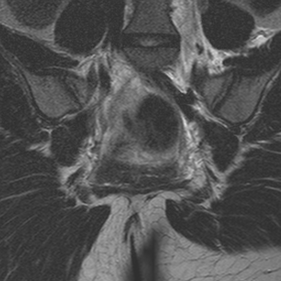 File:Bicornuate uterus (Radiopaedia 24677-24949 Coronal T2 17).jpg