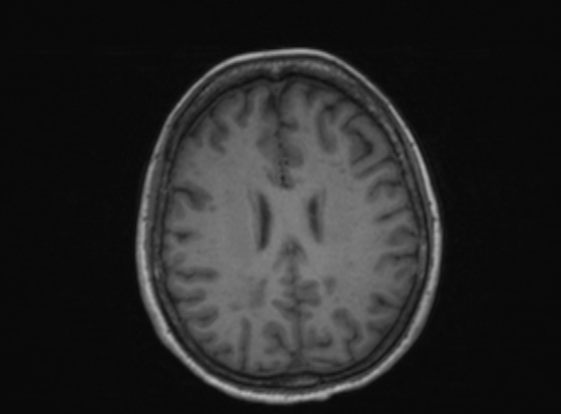 Bilateral PCA territory infarction - different ages (Radiopaedia 46200-51784 Axial T1 197).jpg