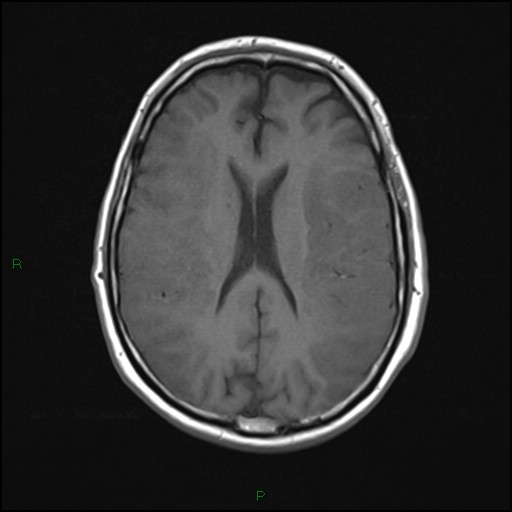 File:Bilateral acute middle cerebral artery territory infarcts (Radiopaedia 77319-89402 Axial T1 15).jpg