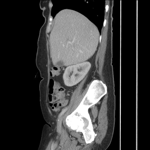 Bilateral adrenal granulocytic sarcomas (chloromas) (Radiopaedia 78375-91007 C 48).jpg
