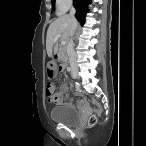 File:Bilateral adrenal granulocytic sarcomas (chloromas) (Radiopaedia 78375-91007 C 66).jpg