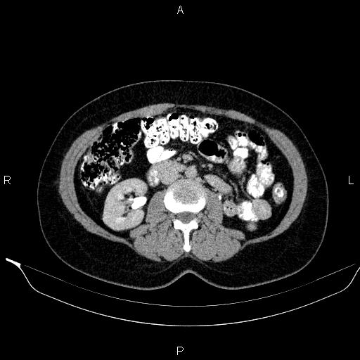 Bilateral adrenal myelolipoma (Radiopaedia 63058-71535 Axial C+ delayed 65).jpg