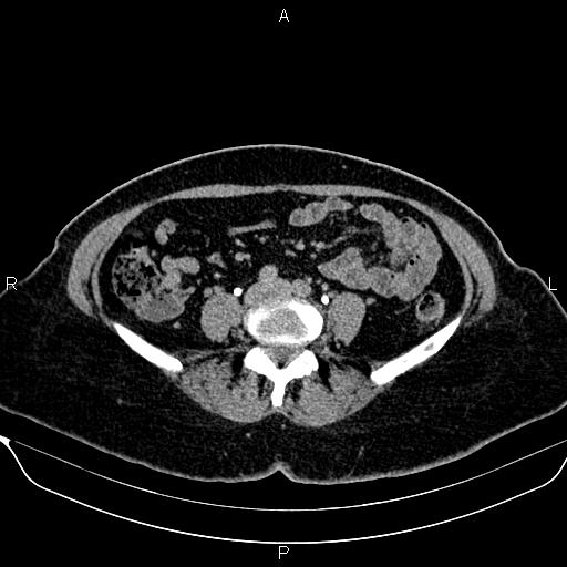 Bilateral benign adrenal adenomas (Radiopaedia 86912-103124 Axial C+ delayed 102).jpg