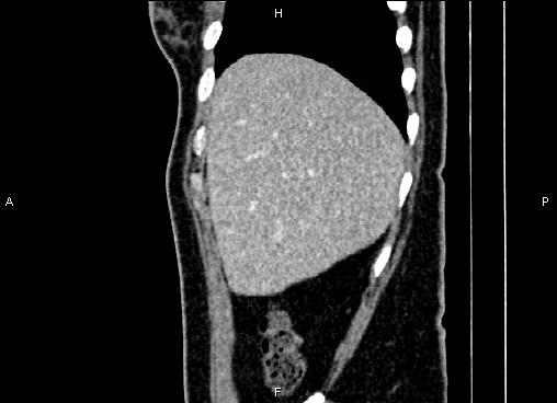 Bilateral benign adrenal adenomas (Radiopaedia 86912-103124 E 14).jpg