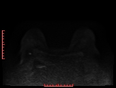 File:Bilateral breast implant rupture (Radiopaedia 24761-25027 DWI 11).jpg