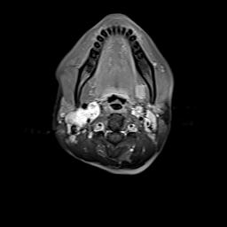 File:Bilateral carotid body tumors and right jugular paraganglioma (Radiopaedia 20024-20060 Axial 97).jpg