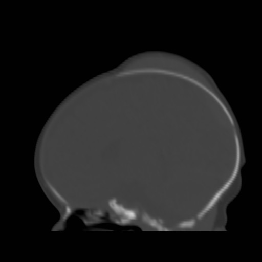 File:Bilateral cephalohematomas and subdural hematomas (Radiopaedia 26778-26929 Sagittal bone window 19).jpg
