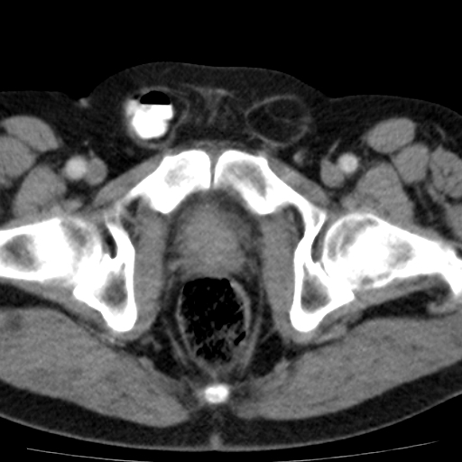 File:Bilateral direct inguinal herniae (Radiopaedia 17016-16719 B 22).jpg