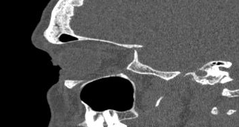 File:Bilateral ectopic infraorbital nerves (Radiopaedia 49006-54084 Sagittal 32).png