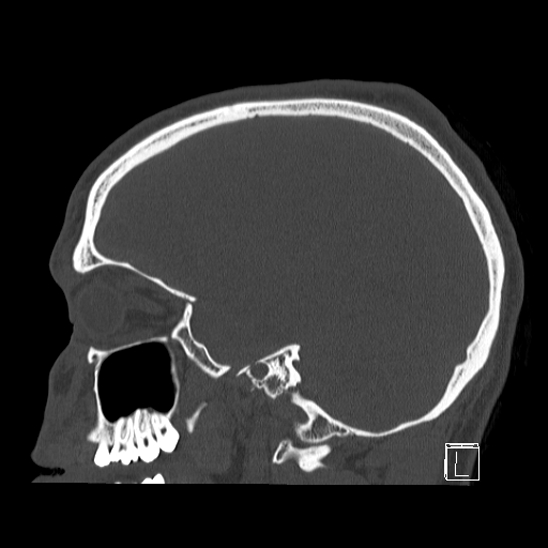 Bilateral occipital condyle fracture (type 2) (Radiopaedia 87675-104089 Sagittal bone window 78).jpg
