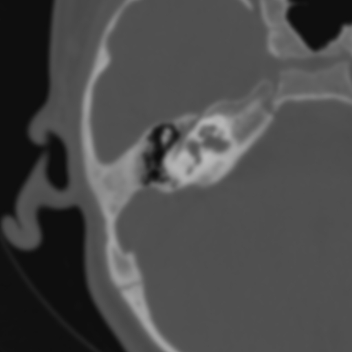 Bilateral otosclerosis (Radiopaedia 57237-64157 B 61).jpg