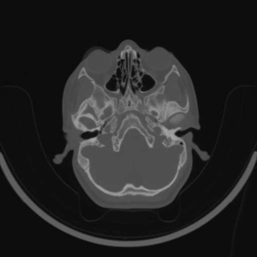 Bilateral otosclerosis (Radiopaedia 57237-64157 C 30).jpg