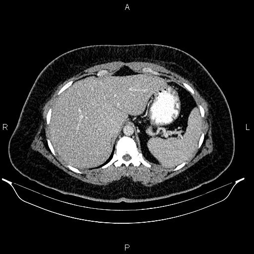 Bilateral ovarian dermoid cysts (Radiopaedia 85785-101603 A 25).jpg