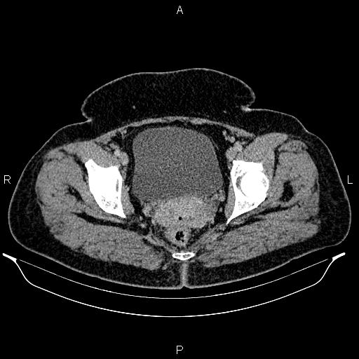 Bilateral ovarian dermoid cysts (Radiopaedia 85785-101603 A 99).jpg