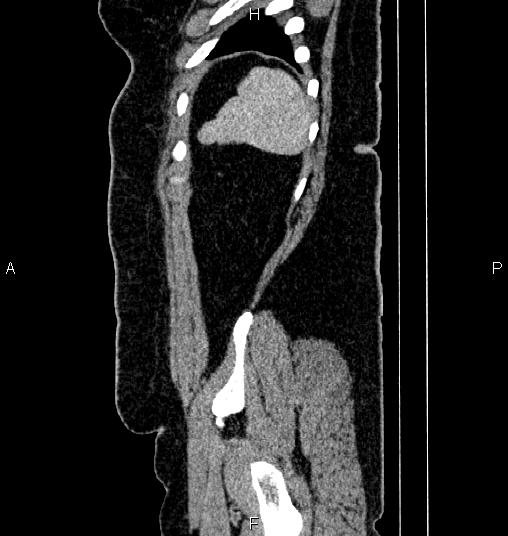 Bilateral ovarian dermoid cysts (Radiopaedia 85785-101603 D 86).jpg