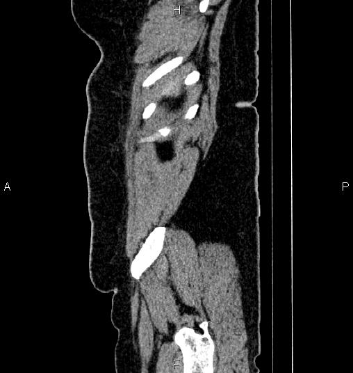 Bilateral ovarian dermoid cysts (Radiopaedia 85785-101603 D 92).jpg