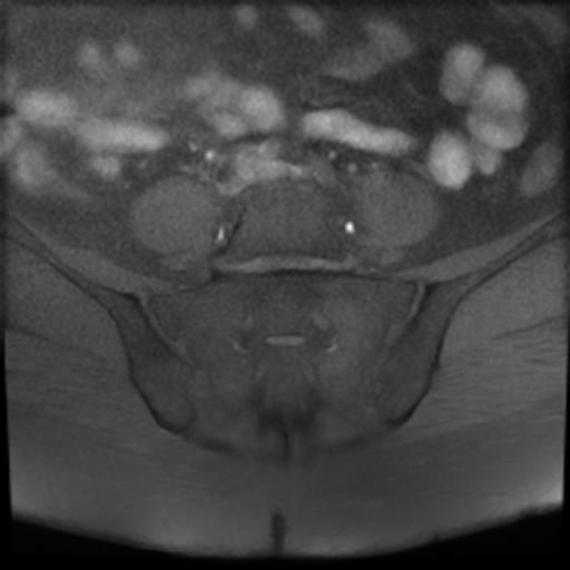File:Bilateral ovarian dermoid cysts (Radiopaedia 90152-107338 Axial T1 fat sat 1).jpg