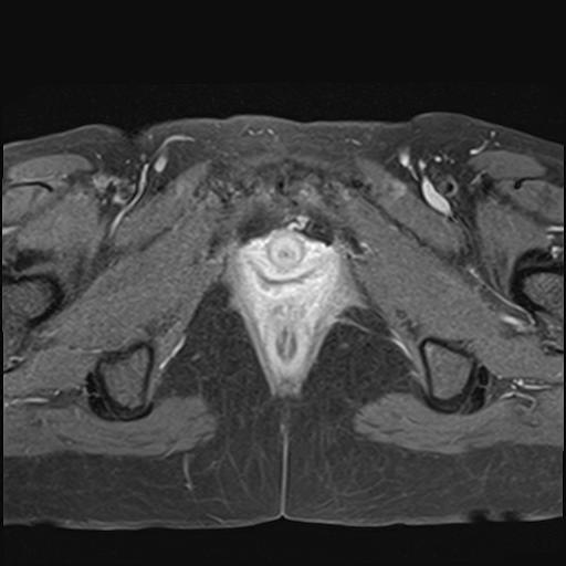 File:Bilateral ovarian endometriomas (Radiopaedia 87085-103347 Axial T1 C+ fat sat 21).jpg