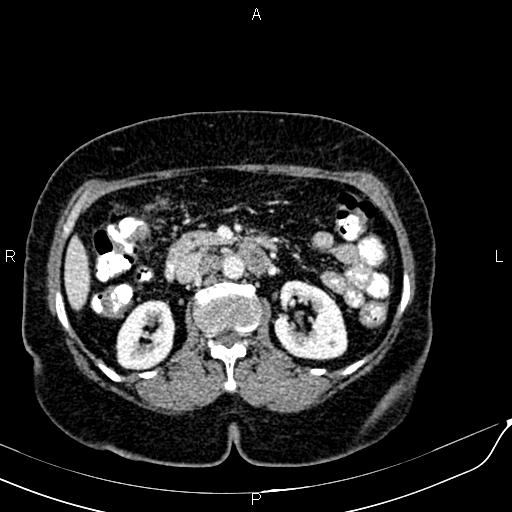 Bilateral ovarian serous cystadenocarcinoma (Radiopaedia 86062-101989 B 41).jpg