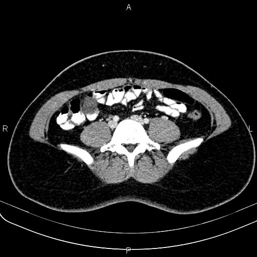 Bilateral ovarian teratoma (Radiopaedia 83131-97503 Axial With contrast 5).jpg