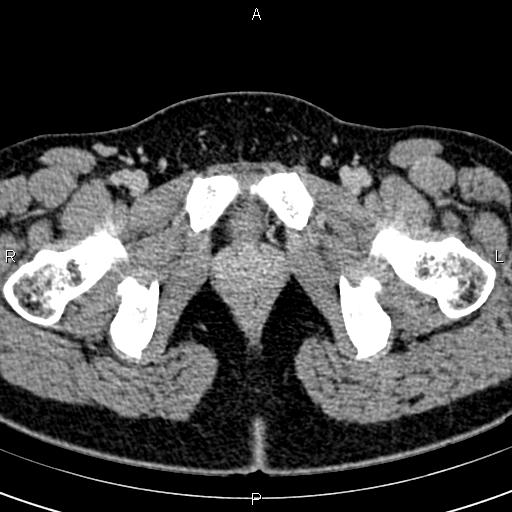 File:Bilateral ovarian teratoma (Radiopaedia 83131-97503 B 79).jpg