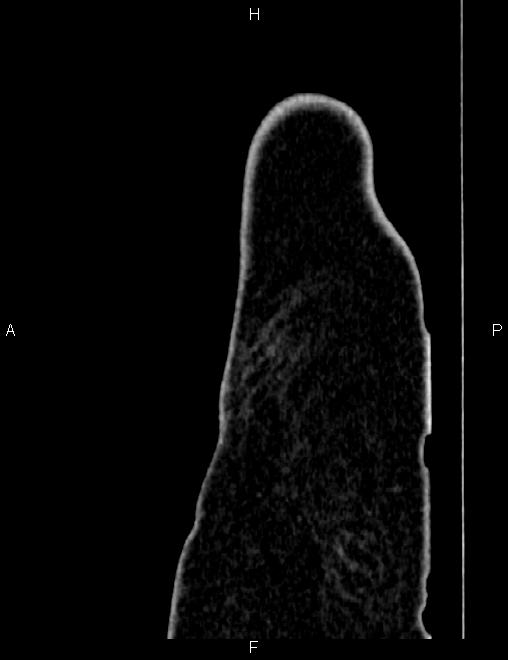 Bilateral ovarian teratoma (Radiopaedia 83131-97503 D 8).jpg