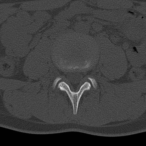 Bilateral pars defect (Radiopaedia 26691-26846 Axial bone window 13).jpg