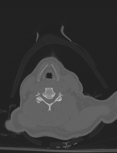 Bilateral perched facet joint (Radiopaedia 63149-71669 Axial bone window 38).jpg