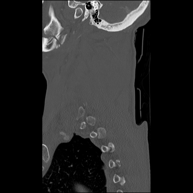 Bilateral perched facets with cord injury (Radiopaedia 45587-49713 Sagittal bone window 46).jpg
