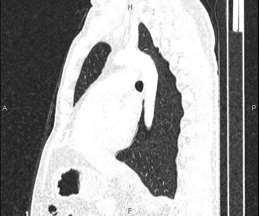 Bilateral pulmonary AVM (Radiopaedia 83134-97505 Sagittal lung window 68).jpg