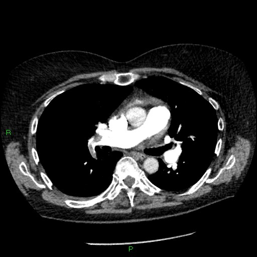 File:Bilateral pulmonary emboli (Radiopaedia 32700-33669 Axial C+ CTPA 50).jpg