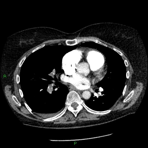 Bilateral pulmonary emboli (Radiopaedia 32700-33669 Axial C+ CTPA 59).jpg