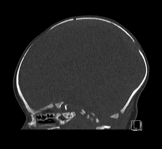 Bilateral subdural hemorrhage and parietal skull fracture (Radiopaedia 26058-26192 Sagittal bone window 56).png