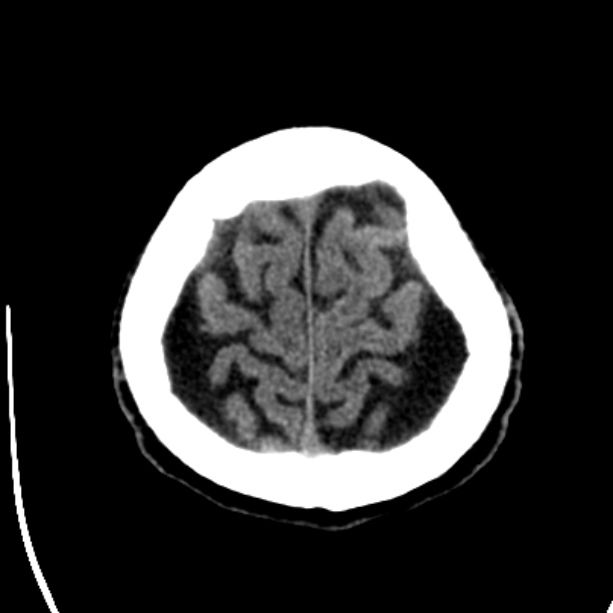 Bilateral subdural hygromata (Radiopaedia 29245-29656 Axial non-contrast 43).jpg