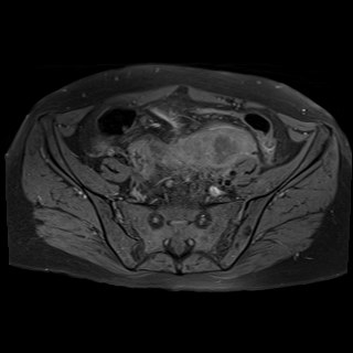 Bilateral tubo-ovarian abscesses (Radiopaedia 58635-65829 Axial T1 fat sat 10).jpg