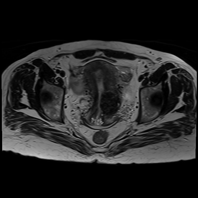 Bilateral tubo-ovarian abscesses (Radiopaedia 58635-65829 Axial T2 29).jpg