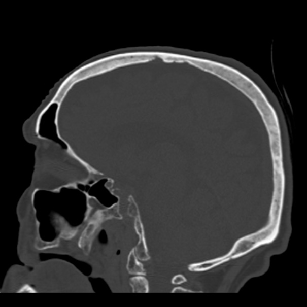 Biparietal osteodystrophy (Radiopaedia 46109-50463 Sagittal bone window 47).jpg