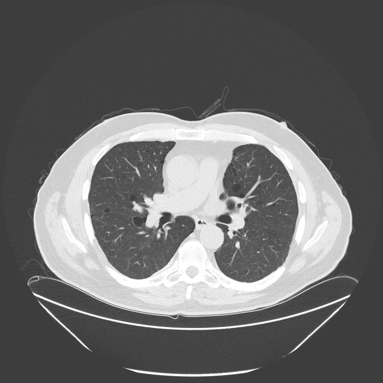 Birt-Hogg-Dubé syndrome (Radiopaedia 52578-58491 Axial lung window 30).jpg