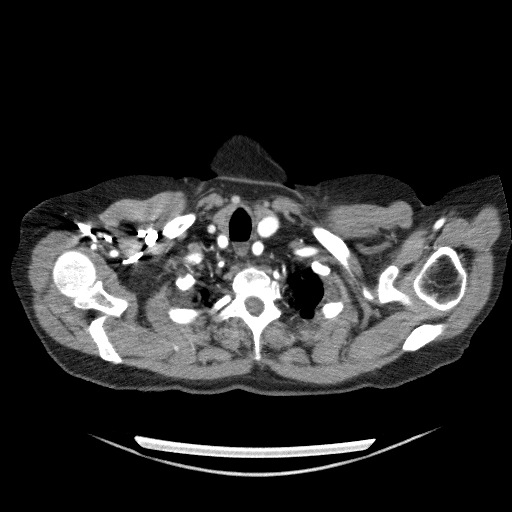 File:Bladder tumor detected on trauma CT (Radiopaedia 51809-57609 A 12).jpg