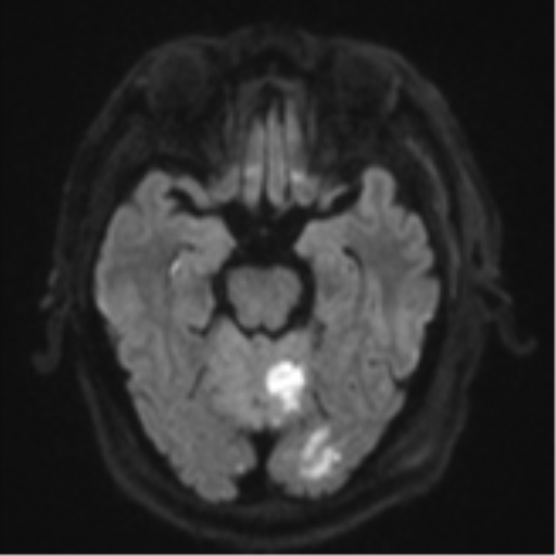 File:Blunt cerebrovascular injury (Radiopaedia 53682-59745 Axial DWI 42).png