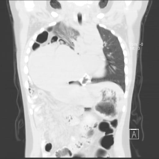 File:Bochdalek diaphragmatic hernia (Radiopaedia 38866-41059 Coronal lung window 10).jpg